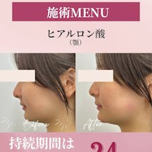 【女性・輪郭】ヒアルロン酸(あご)_before_aftar