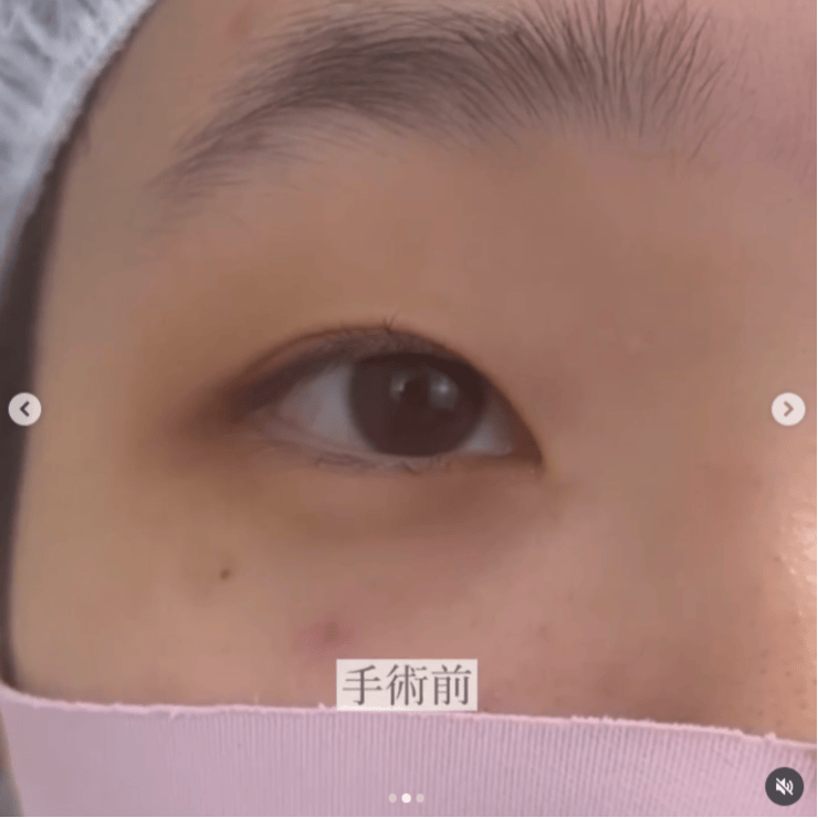 【女性・目元】二重埋没法＋目頭切開_before