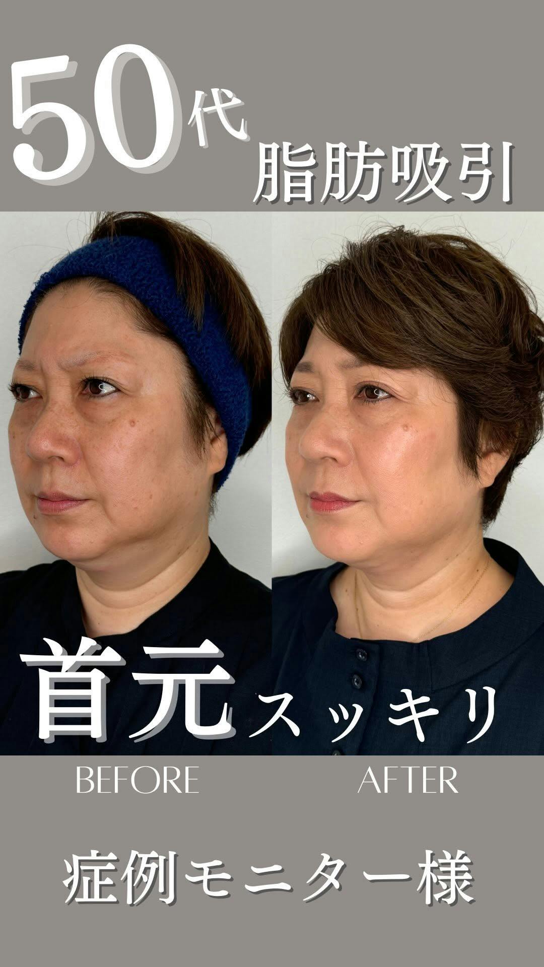 【50代女性・アゴ】脂肪吸引（アゴ下のみ）_before_aftar