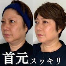 【50代女性・アゴ】脂肪吸引(アゴ下のみ)_before_aftar
