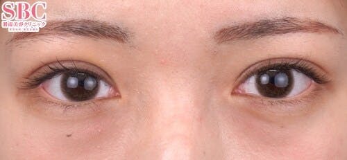 【20代女性・目元】クイックコスメティーク・トリプルNeo_1week