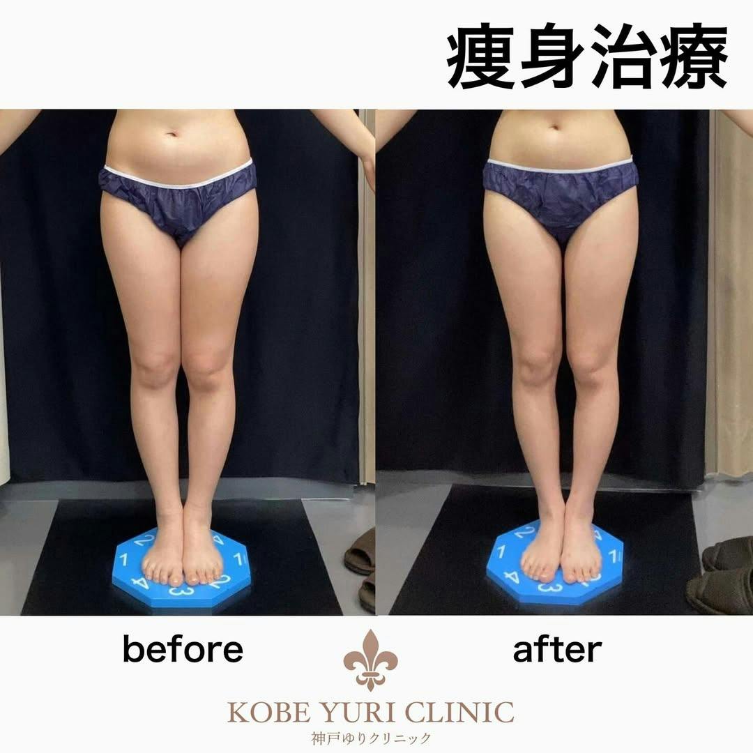 【女性・足】痩身治療_before_aftar