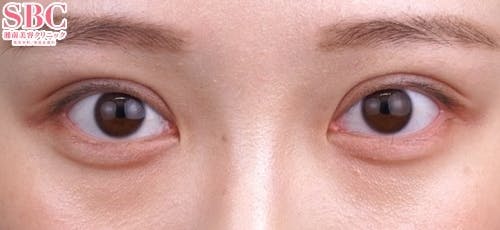 【20代女性・目元】クイックコスメティーク・トリプルNeo_after