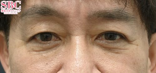 【男性・目元】目の下の切らないクマ・たるみ（ふくらみ）取り、ナチュラル脂肪注射コンデンスリッチ、ナチュラル脂肪注射ナノリッチ_after