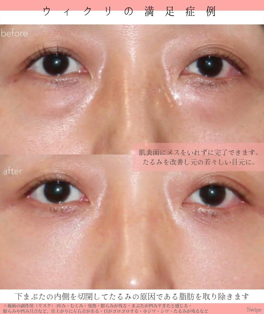 【女性・目元】たるみ_before_aftar