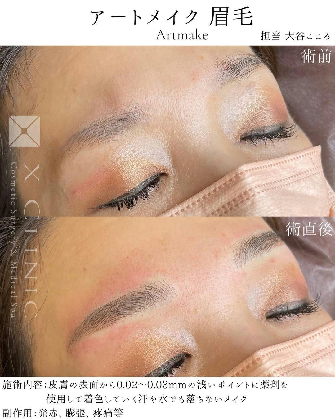 【女性・眉】眉毛アートメイク_before_aftar