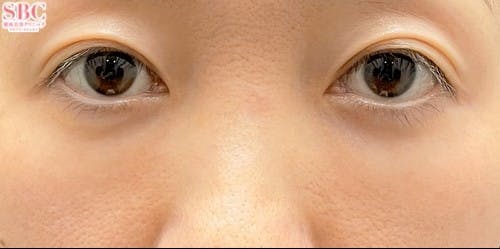 【40代女性・クマ】裏ハムラ法 ナチュラル脂肪注射ナノリッチ_after