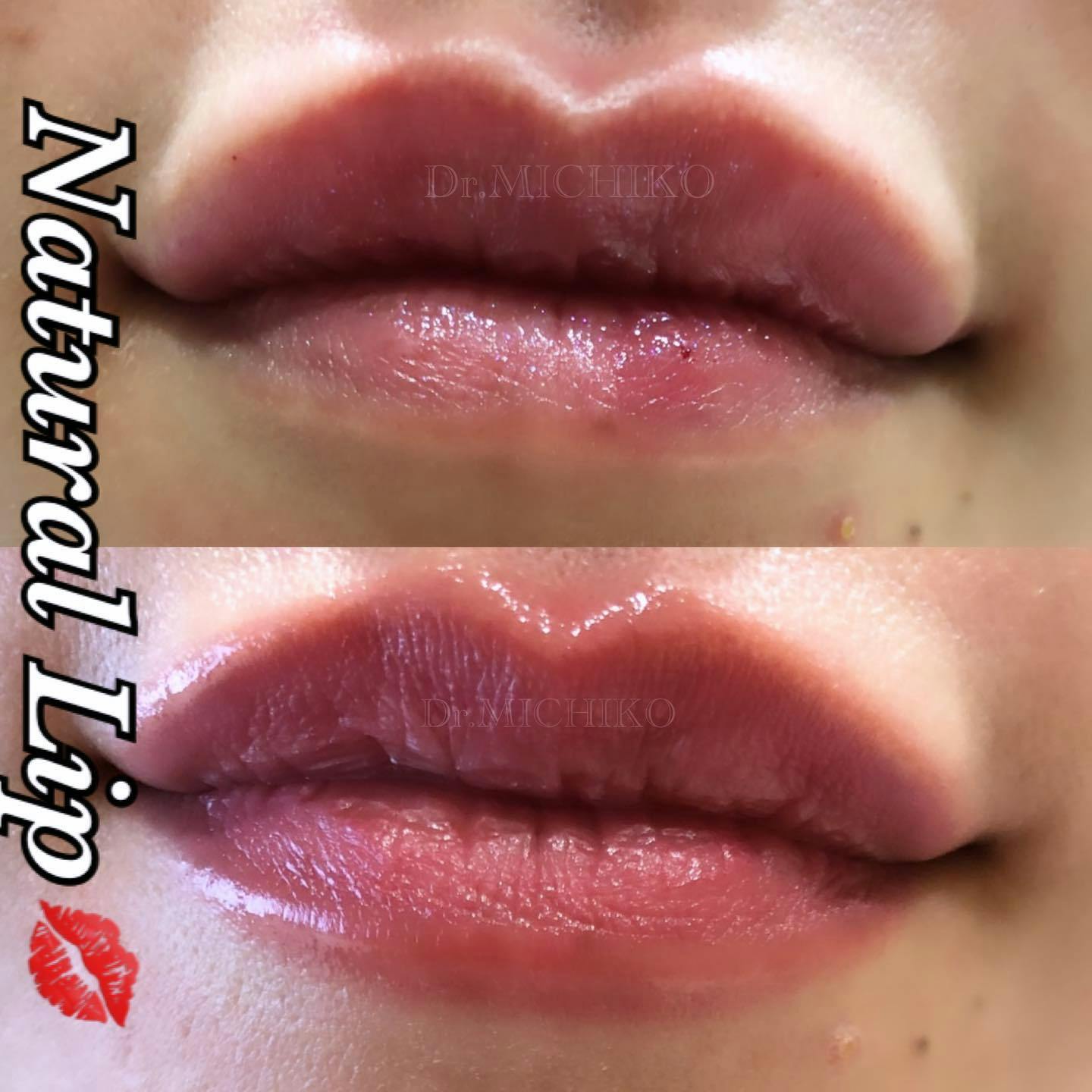 【女性・唇】リップヒアル_before_aftar