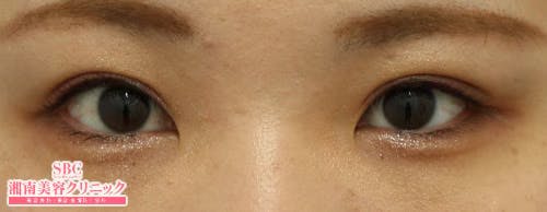 【女性・目元】クイックコスメティーク・ダブルNeo、自然癒着セット（上眼瞼脱脂）、SBC『デカ目』術_aftar