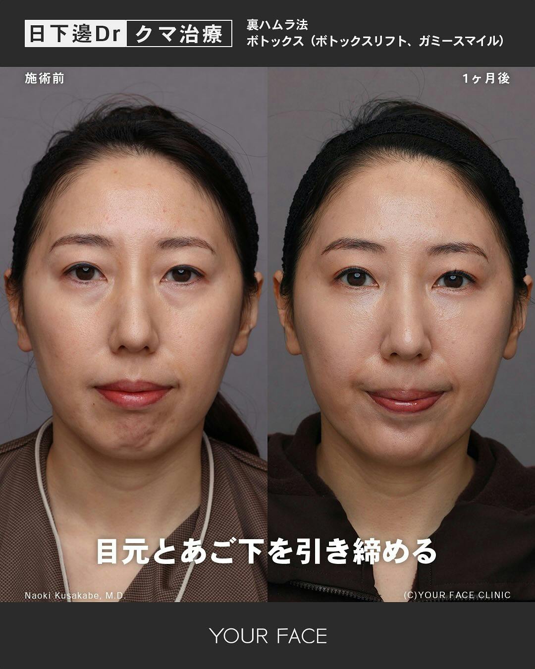 【女性・顔】裏ハムラ法 ボトックス_before_aftar