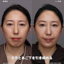 【女性・顔】裏ハムラ法 ボトックス_before_aftar