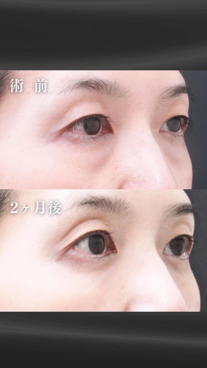 【54歳女性・目元】経結膜脱脂術・眼窩脂肪注入_before_aftar