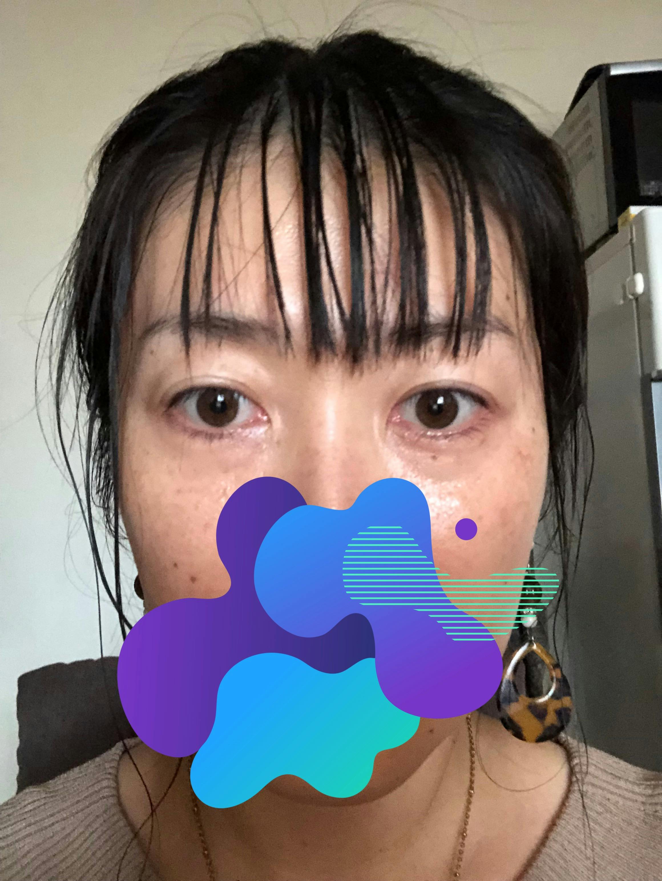 品川美容外科大宮院でを受けたmakkyさんの写真