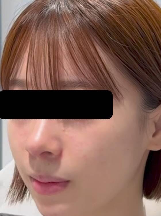 みずほクリニックで鼻整形：鼻プロテーゼ挿入（鼻を高くする）を受けたポートさんの写真