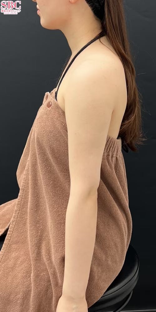 【女性・目元】Aquicell（アキーセル）脂肪吸引、根こそぎVASER脂肪吸引_after