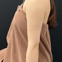 【女性・目元】Aquicell(アキーセル)脂肪吸引、根こそぎVASER脂肪吸引_after