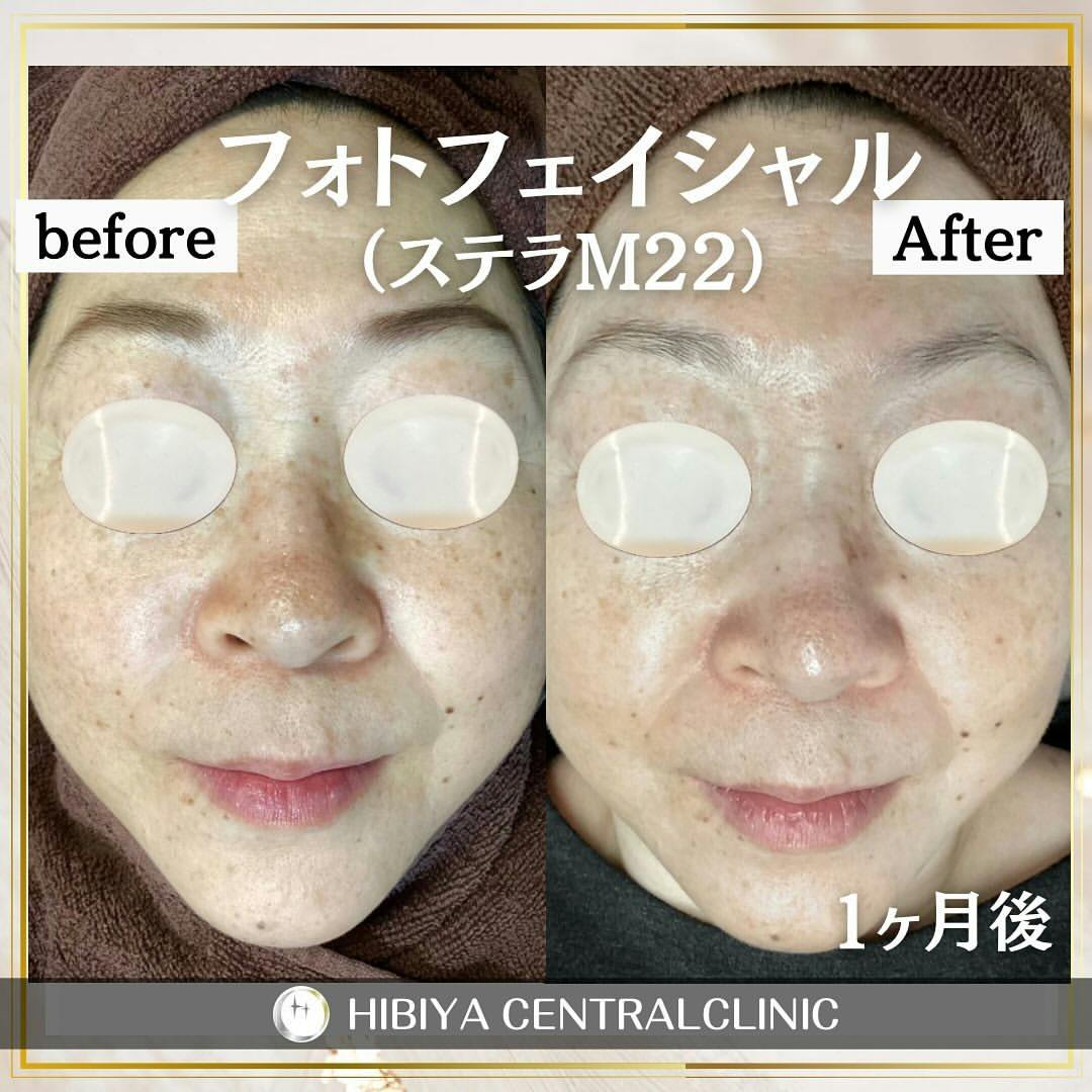 【女性・そばかす】フォトフェイシャル（ステラM22）_before_aftar
