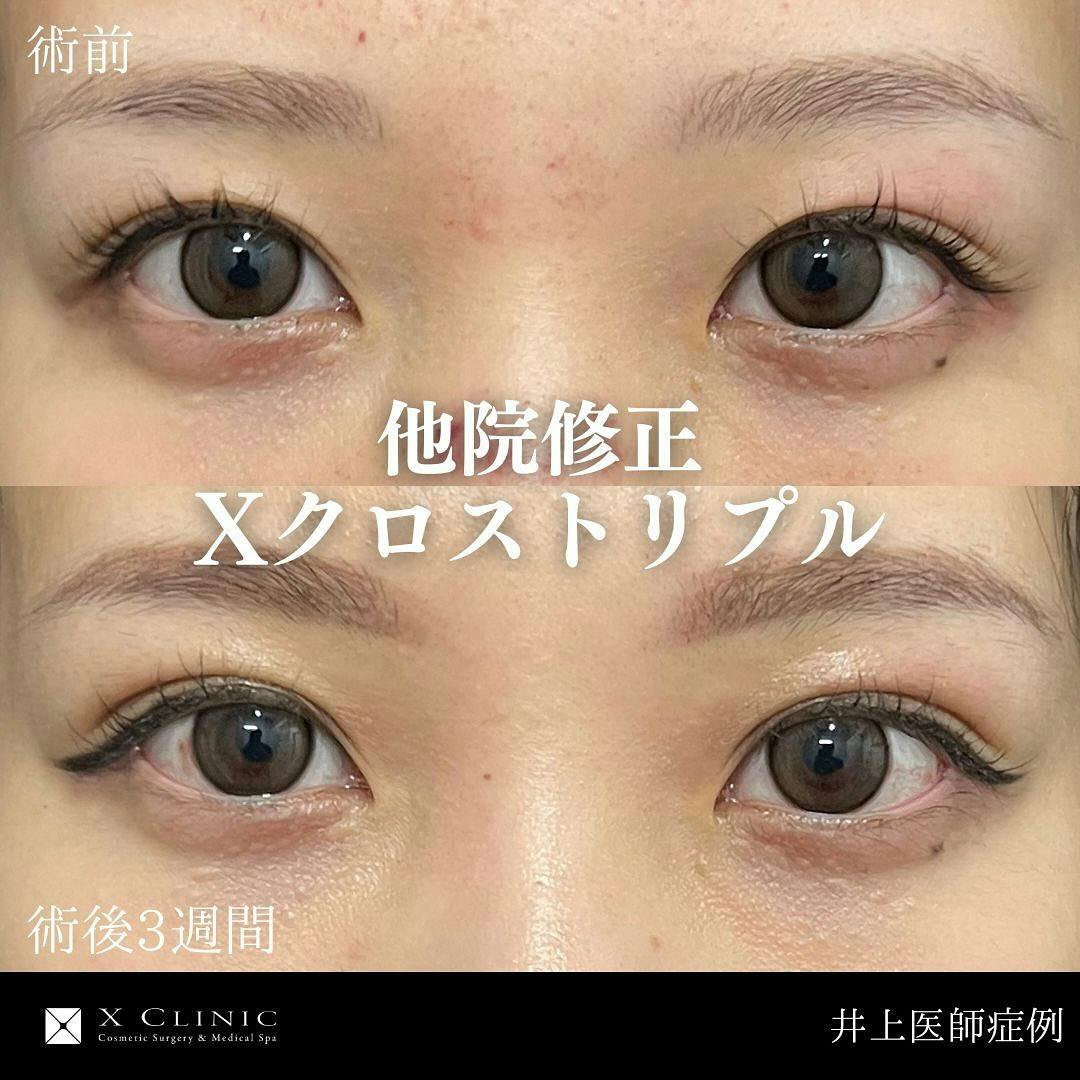 【女性・目元】Xクロストリプル_before_aftar