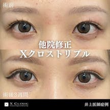 【女性・目元】Xクロストリプル_before_aftar