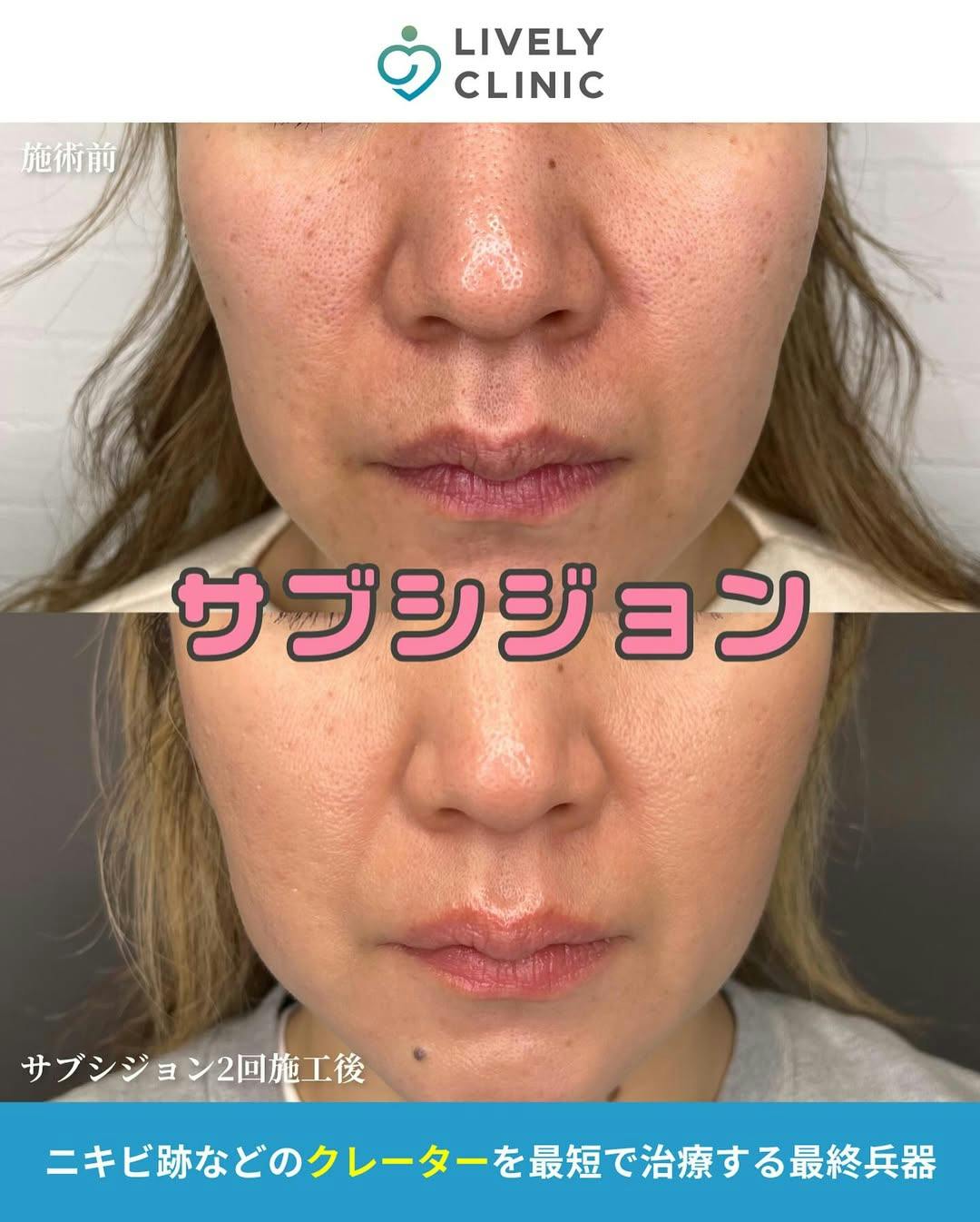 【女性・顔】サブシジョンbefore.after