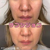 【女性・顔】サブシジョンbefore.after
