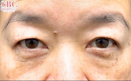 【目元】切開ハムラ(表ハムラ)法_before