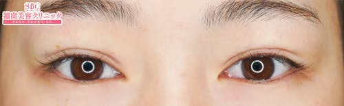 【女性・目元】クイックコスメティーク・ダブルNeo_justafter