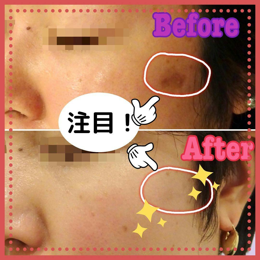 【女性・シミ】ピコレーザー_before_aftar