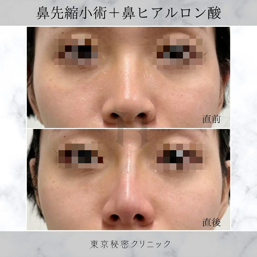 【女性・鼻】鼻先縮小術 ヒアルロン酸（鼻）_before_aftar