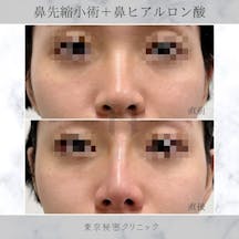 【女性・鼻】鼻先縮小術 ヒアルロン酸(鼻)_before_aftar