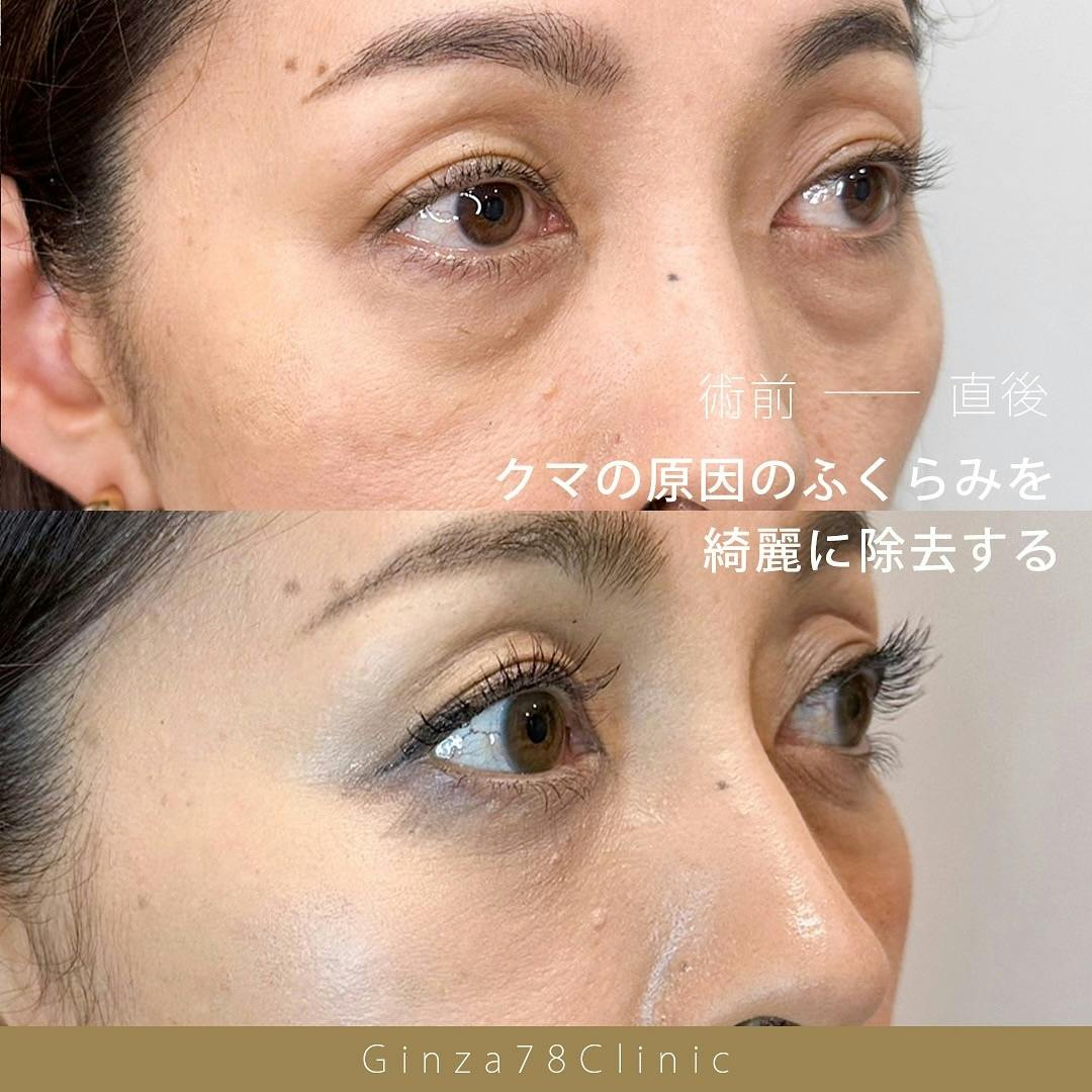 【女性・目元】目の下のクマ取り_before_aftar