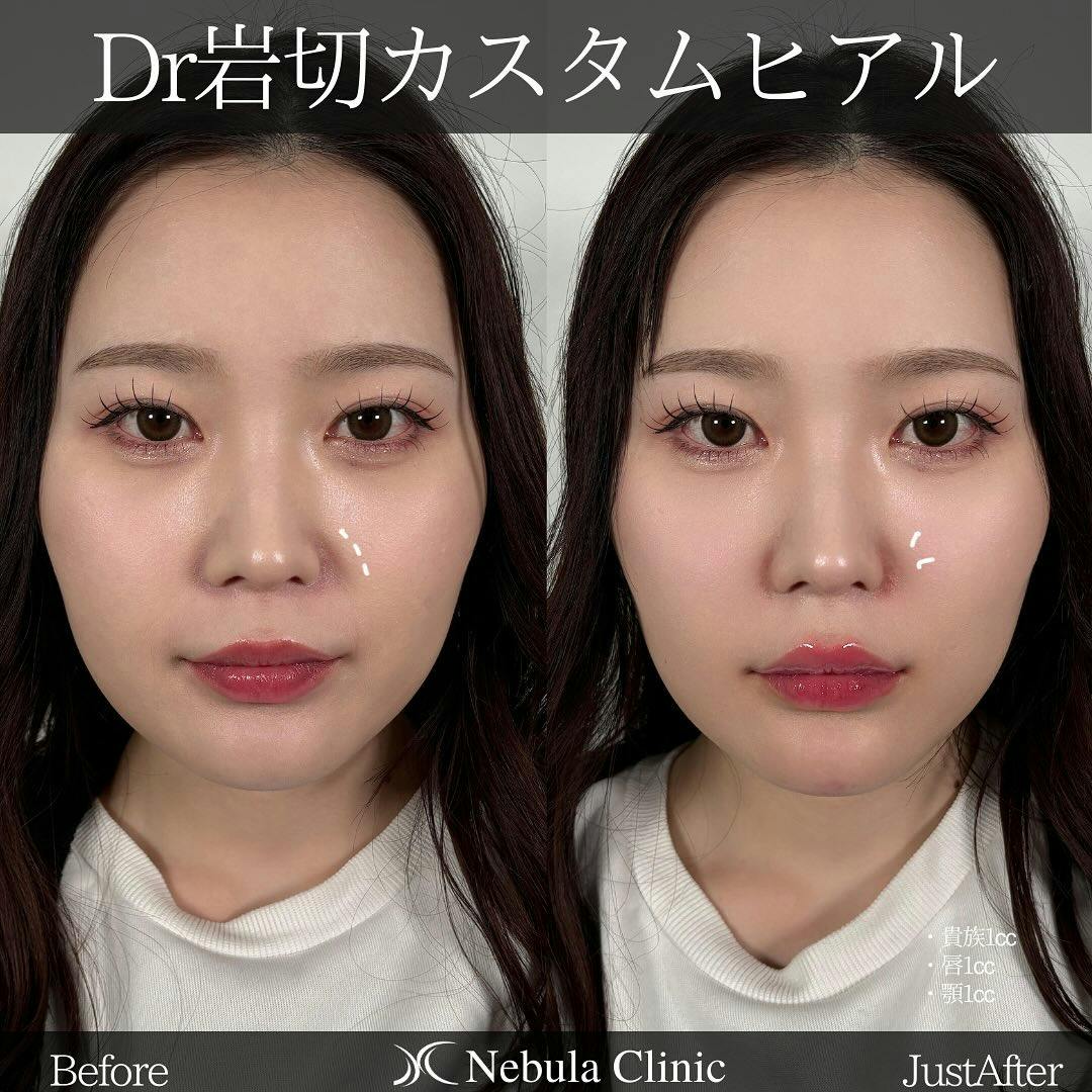 【女性・小鼻・唇・顎】ヒアルロン酸注入(貴族・唇・顎)_before_aftar