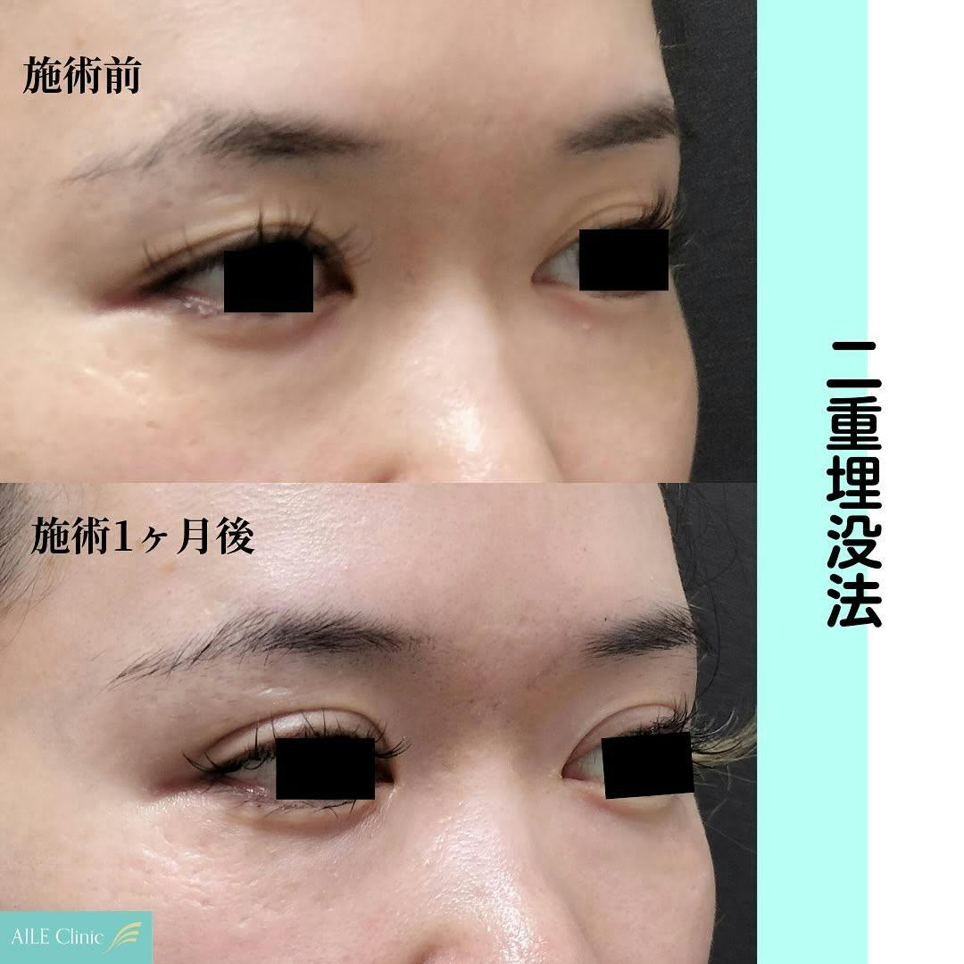 【女性・目元】二重埋没法_before_aftar