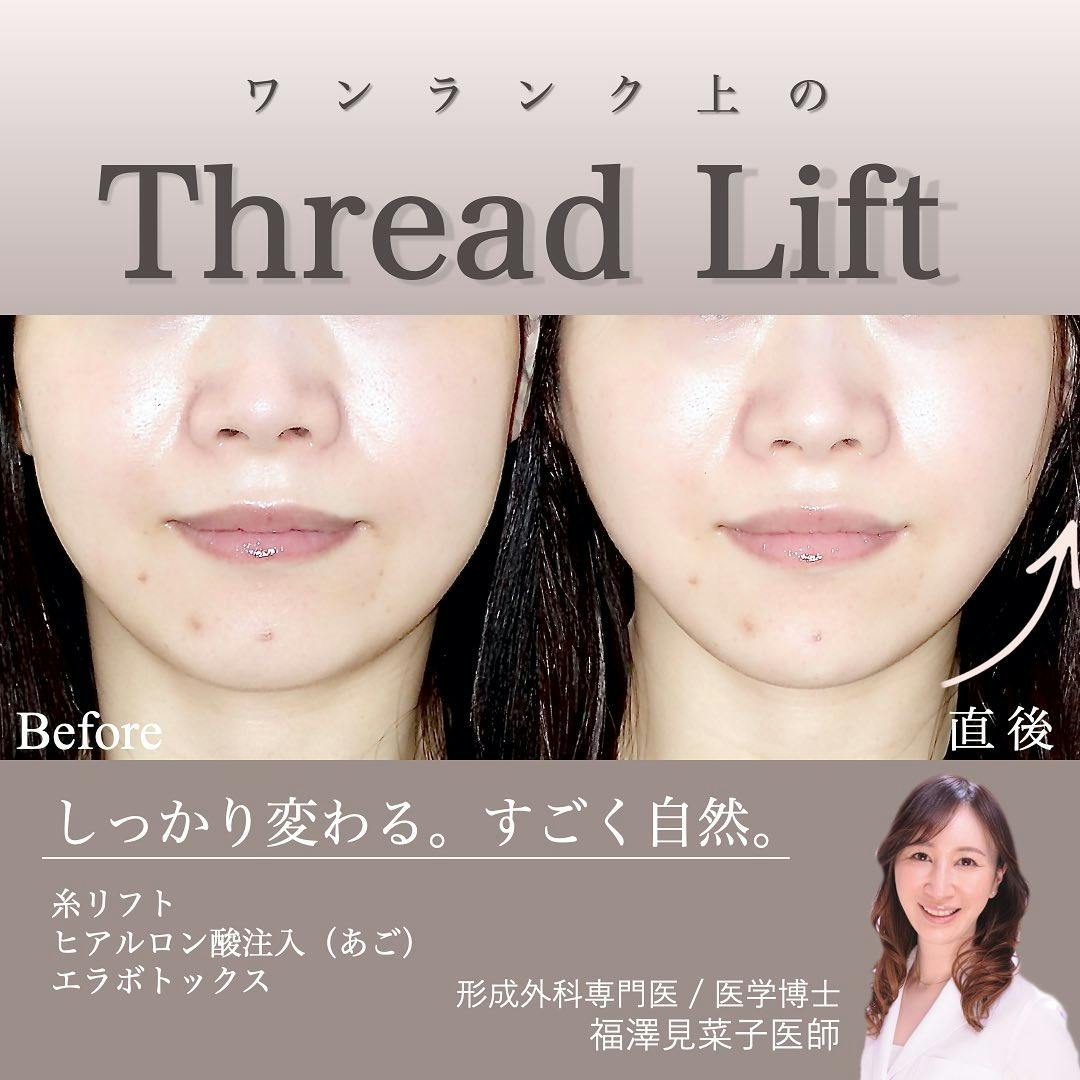 【女性・輪郭】クイックリフト、エラボトックス_before_aftar