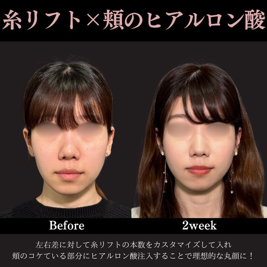 【20代女性・頬】PRISMリフト＋頬のヒアルロン酸注射_before_aftar
