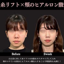 【20代女性・頬】PRISMリフト+頬のヒアルロン酸注射_before_aftar