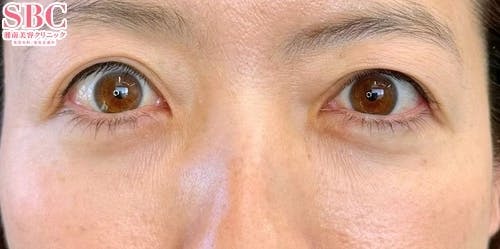 【40代女性・クマ】目の下の切らないクマ・たるみ（ふくらみ）取り_after