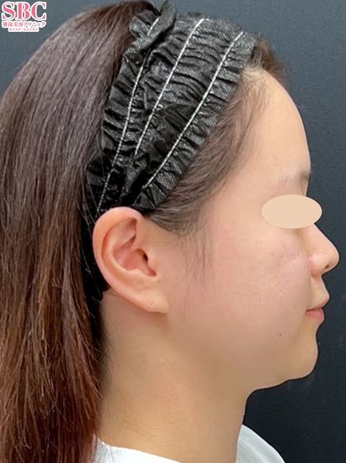 【20代女性・顔】小顔用脂肪吸引注射、バッカルファット除去_before