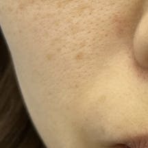 【女性・顔】ブラックピール_before