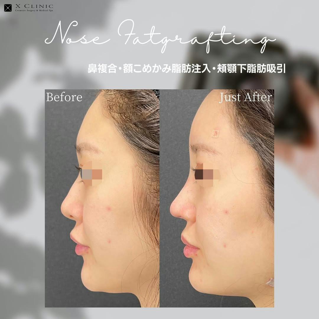 【女性・輪郭】鼻複合·額こめかみ脂肪注入·頬顎下脂肪吸引_before_aftar