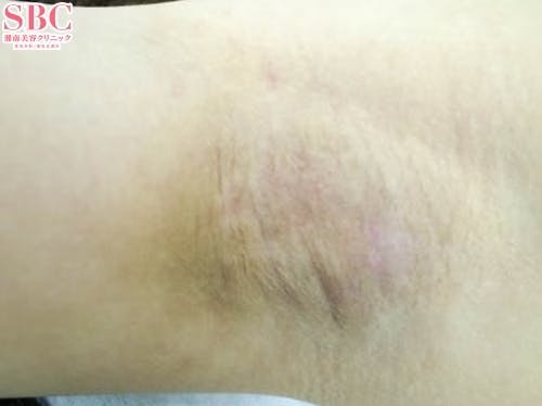 【女性・ワキ】ベイザーシェービング法、シェービング法、完全摘出法_aftar