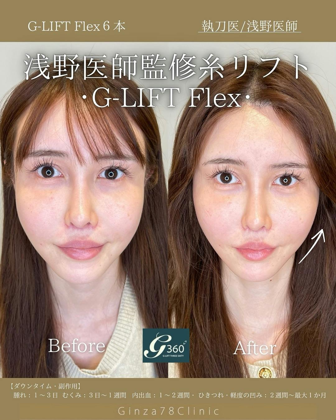 【女性・小顔】糸リフト（G-LIFT Flex）_before_aftar