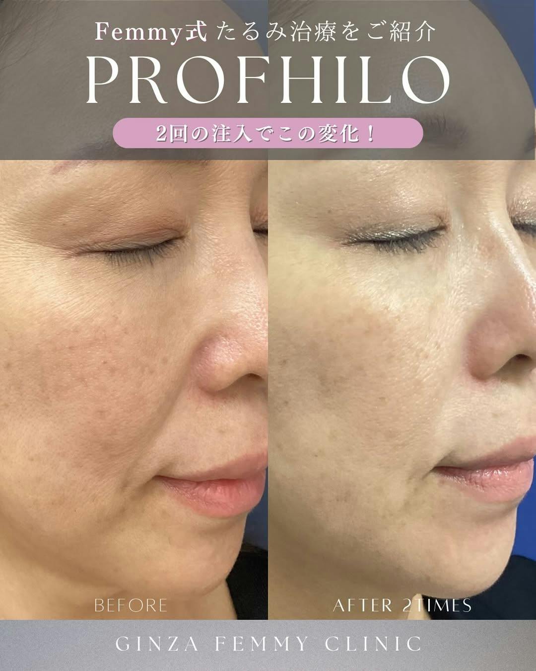 【女性・ほうれい線】プロファイロ_before_aftar