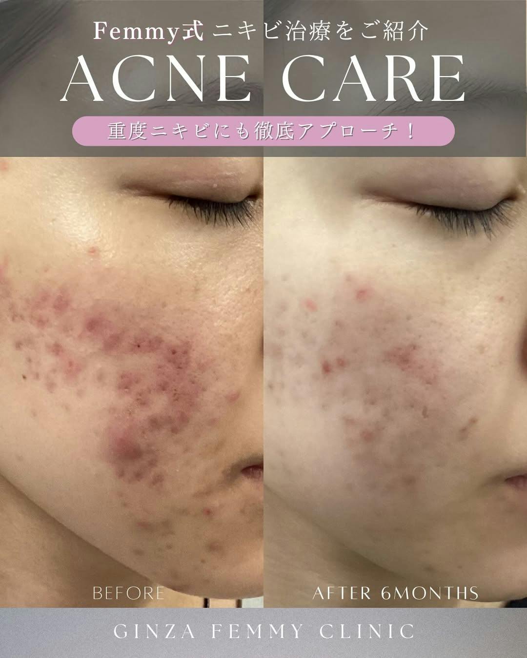 【女性・ニキビ】ケミカルピーリング・クロモライト_before_aftar