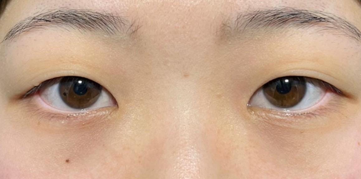 共立美容外科 渋谷院で切らない二重整形：埋没法「共立式二重P-PL挙筋法」を受けた橋本さんの写真