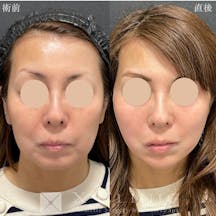 【女性・輪郭】糸リフト ヒアルロン酸_before_aftar