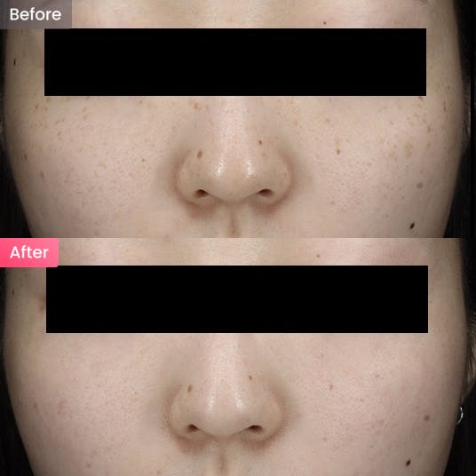 【女性・シミ】頬の細かいシミが気になるの写真
