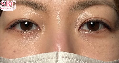 【女性・目元】リジュランHB_after