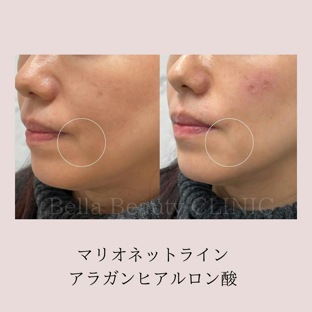 【女性・口元】ヒアルロン酸（マリオネットライン）_before_aftar