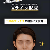 【女性・輪郭】Vライン形成(エラ+オトガイ)、外板除去_aftar